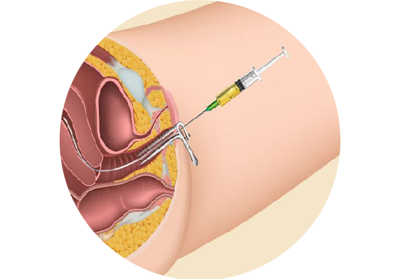 Intra Uterine Insemination