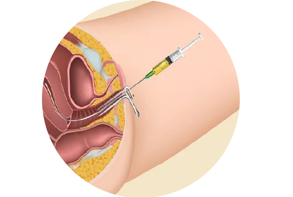 Intra Uterine Insemination (IUI)