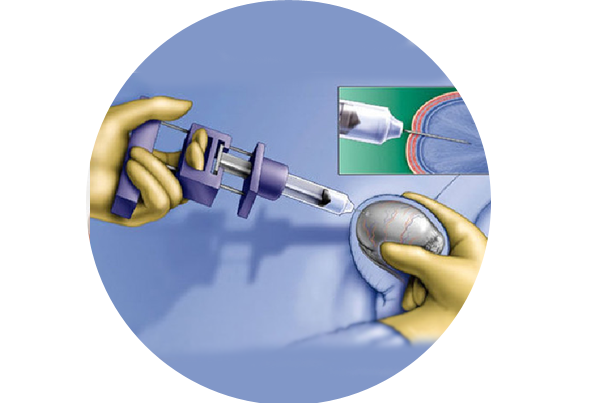 Surgical Sperm Retrieval